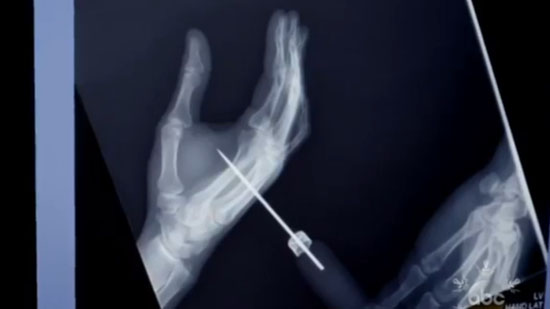 David Blaine Real or Magic röntgenkép a jégvágóról és a kezéről